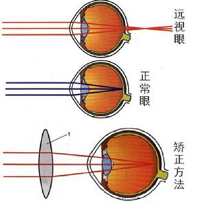 什么是远视眼