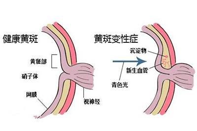 治疗黄斑变性的三个要点