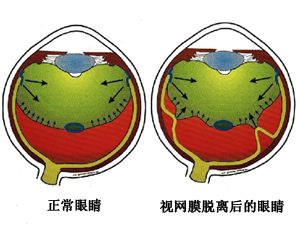 视网膜脱离的症状及治疗方法