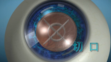 别再凑活看！飞白+三焦晶体，让白内障术后重回高清视野