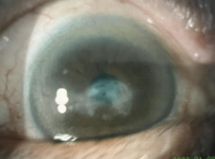 角膜移植供体：*安心吗？会不会有传染病？