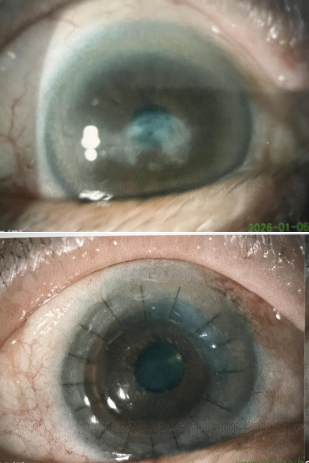 角膜传大爱，生命续华章，致敬无私奉献的角膜捐献者