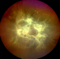 糖尿病盯上“眼底”，警惕这些致盲隐患！